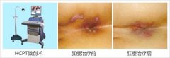 肛瘘闹臭味 医生妙手除