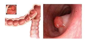 直肠息肉的症状是什么?
