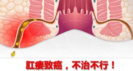 肛瘘患者可别自己给自己治疗 广州东大肛肠医院骗人吗?