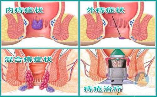 广州东大肛肠医院骗人吗 混合痔患者的饮食原则了解一下